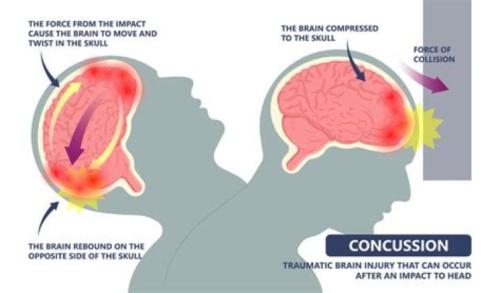 How does concussion affect athletic performance?
