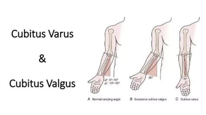 Is LCL valgus or varus?