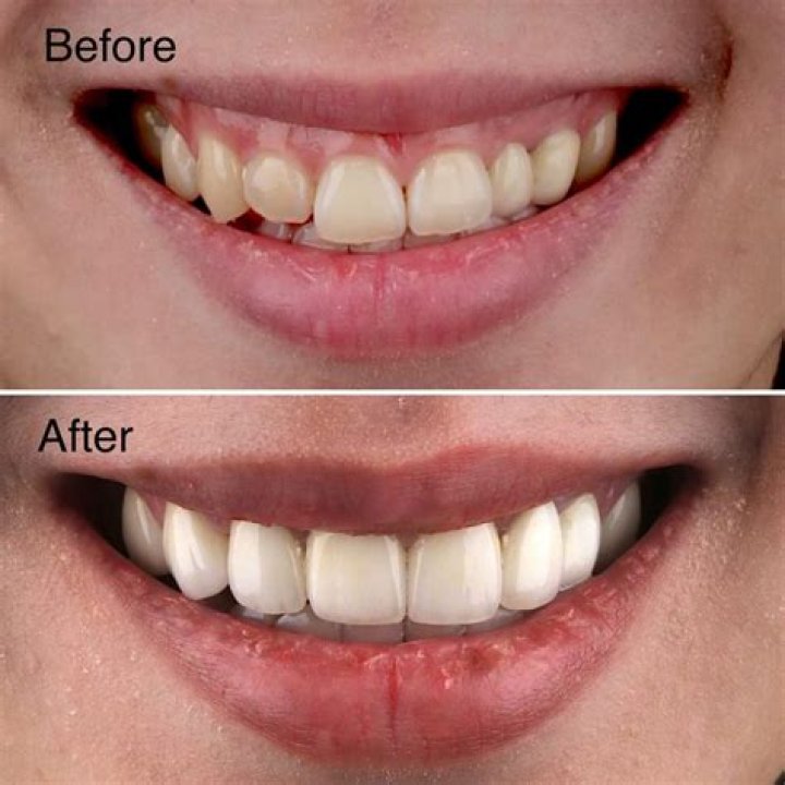 Why did my veneer bubble?